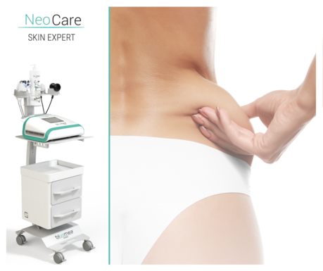 Lipocavitation image