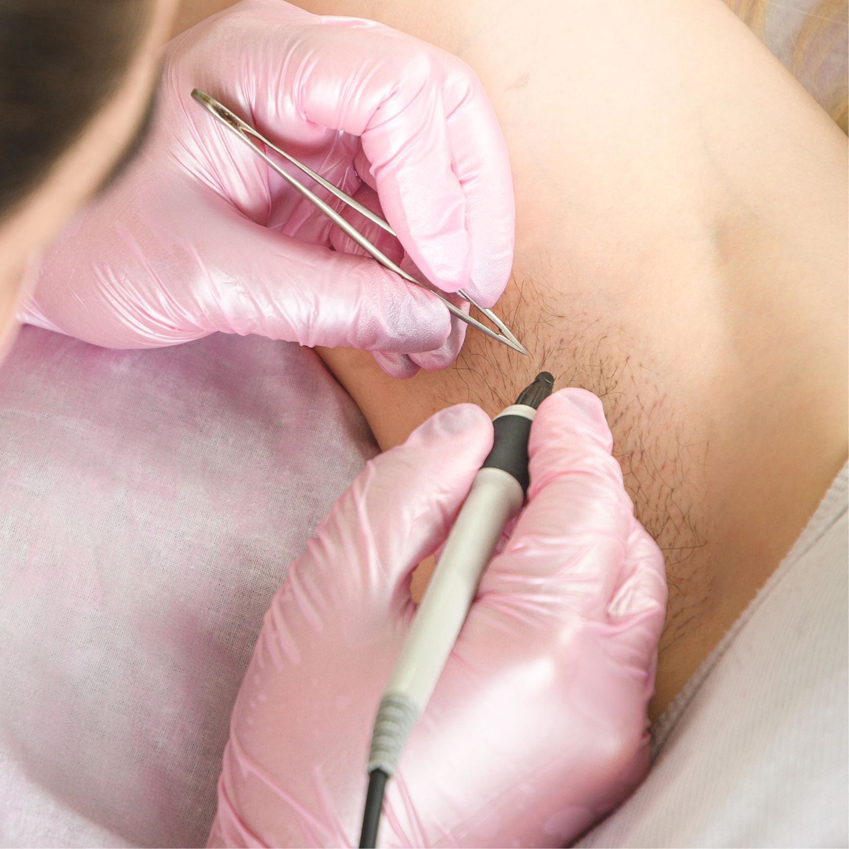 Consultation Electrolyse image