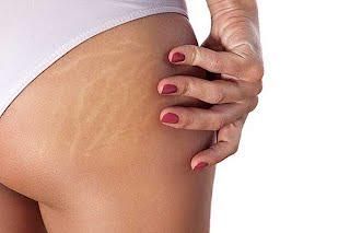 EPILATION INTERFESSIER image
