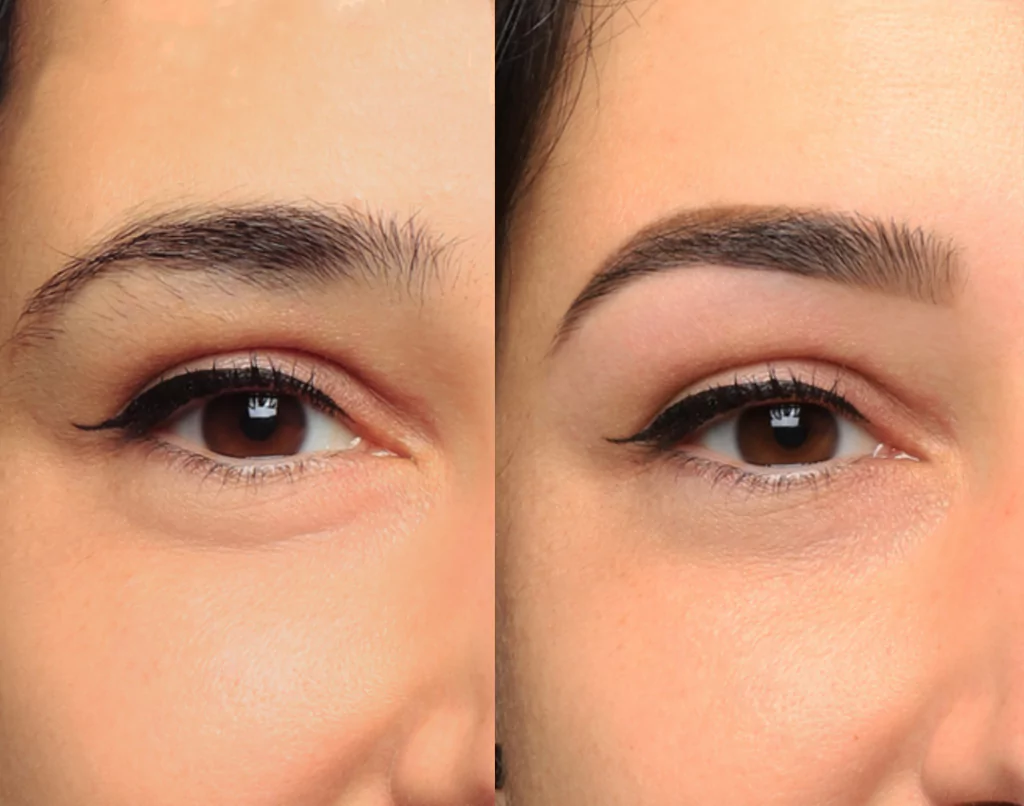 restructuration sourcils image