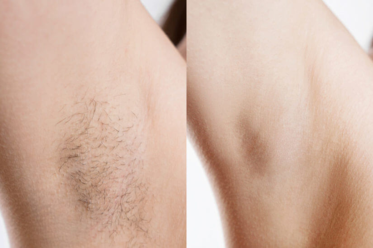 Epilation à la cire - Maillot échancré image
