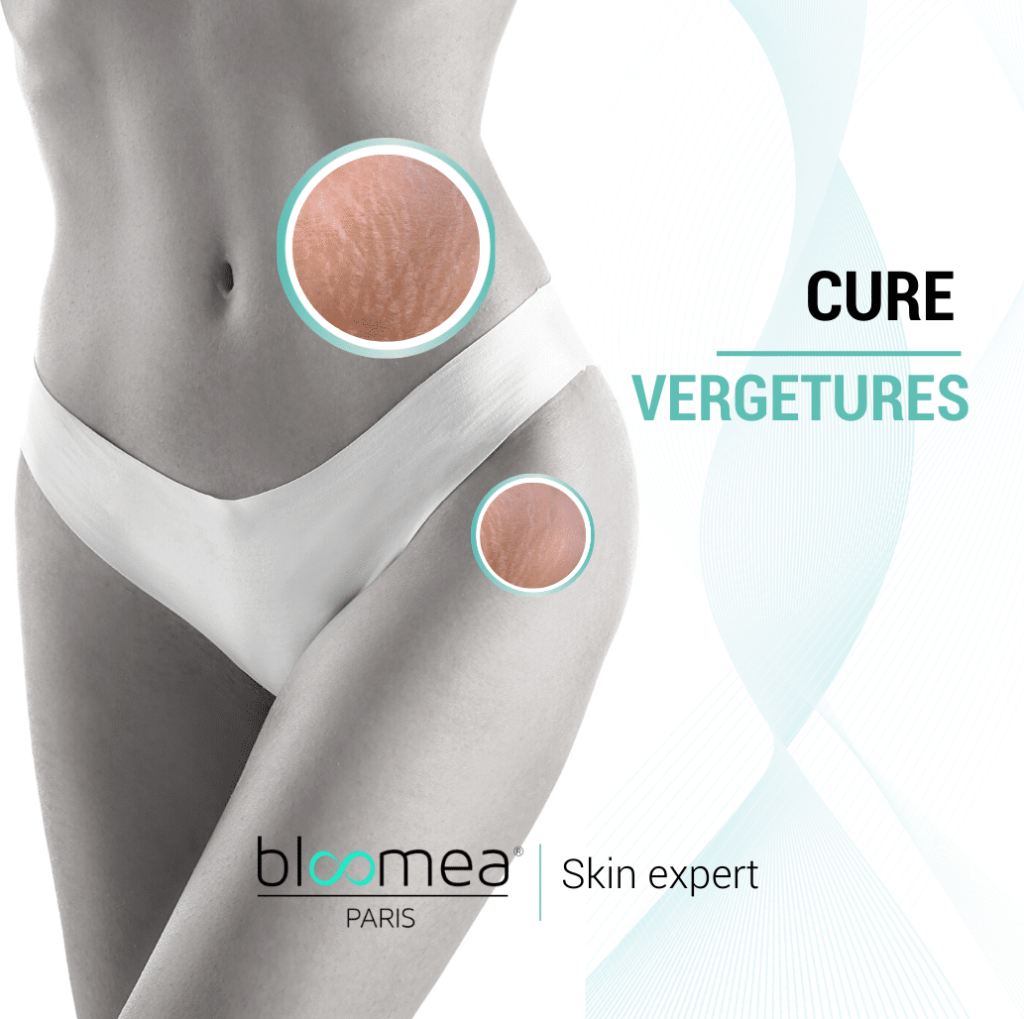 Cure Modeling vergetures image